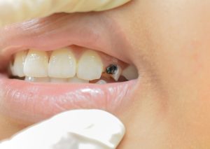 A close-up view of a person who has broken a tooth due to tooth decay.