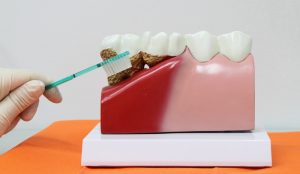 A dental model that is showing what advanced gum disease and gum recession looks like
