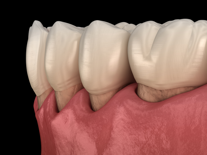 Medical animation of teeth with receding gum lines due to gum disease.