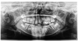 Dental x-ray that shows the internal structure of the teeth and jaws.