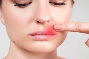Woman that has a mouth sore.