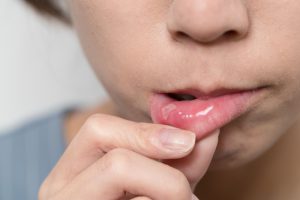 Close-up of a young boy that has a mouth sore.