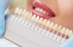 veneers