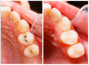 tooth-colored filling