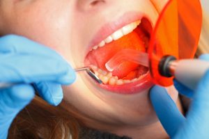 cavity filling