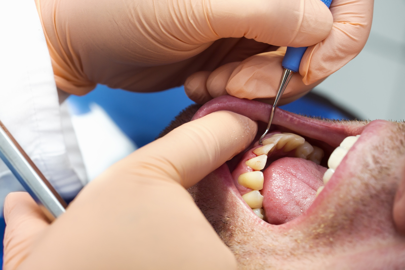 Male dental patient having teeth cleaned by a dentist.